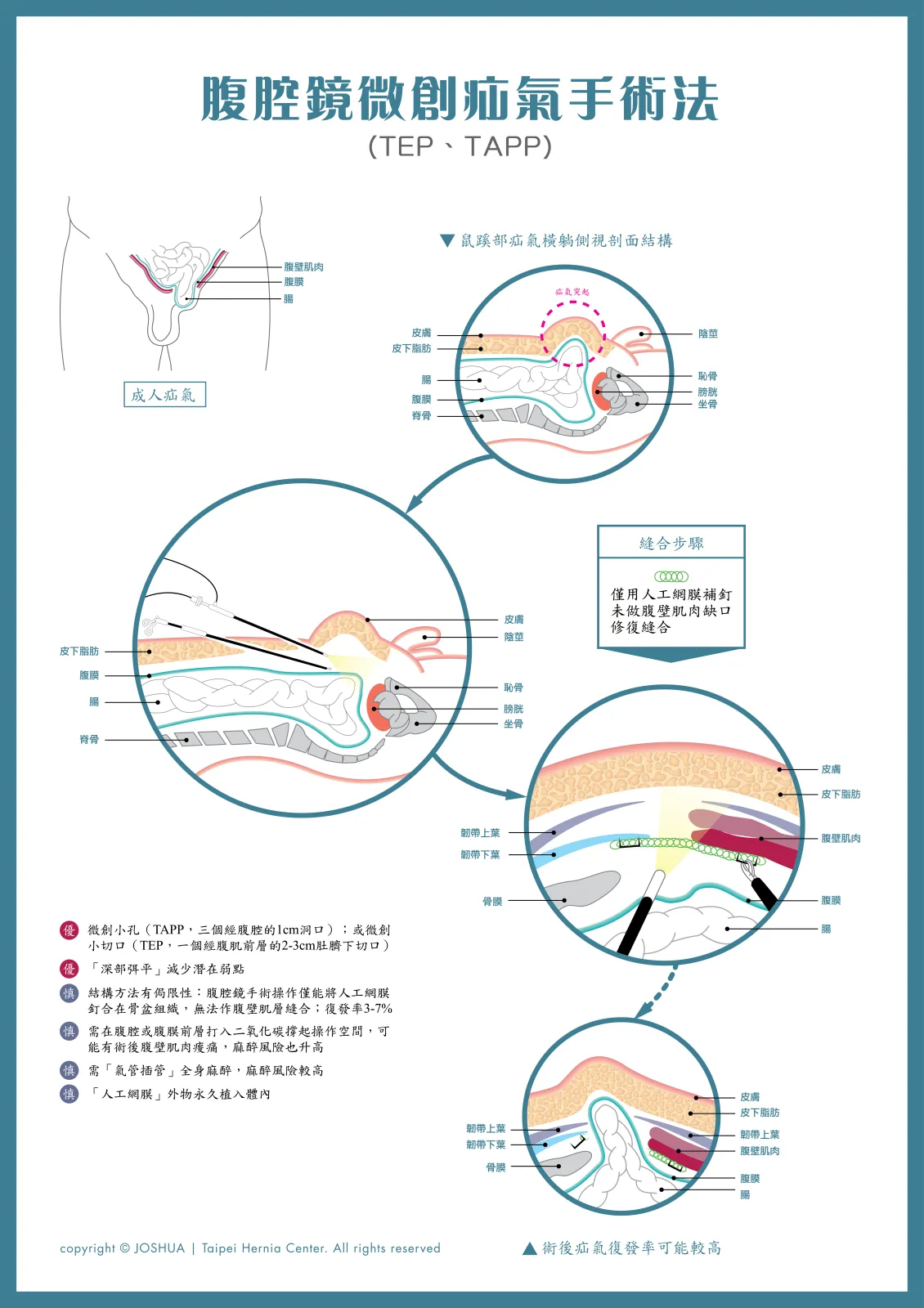 腹腔鏡微創疝氣手術法(TEP、TAPP)海報:橫躺側視剖面圖顯示腹腔鏡器械進入位置,以及人工網膜覆蓋腹壁缺口並以釘合方式固定的示意