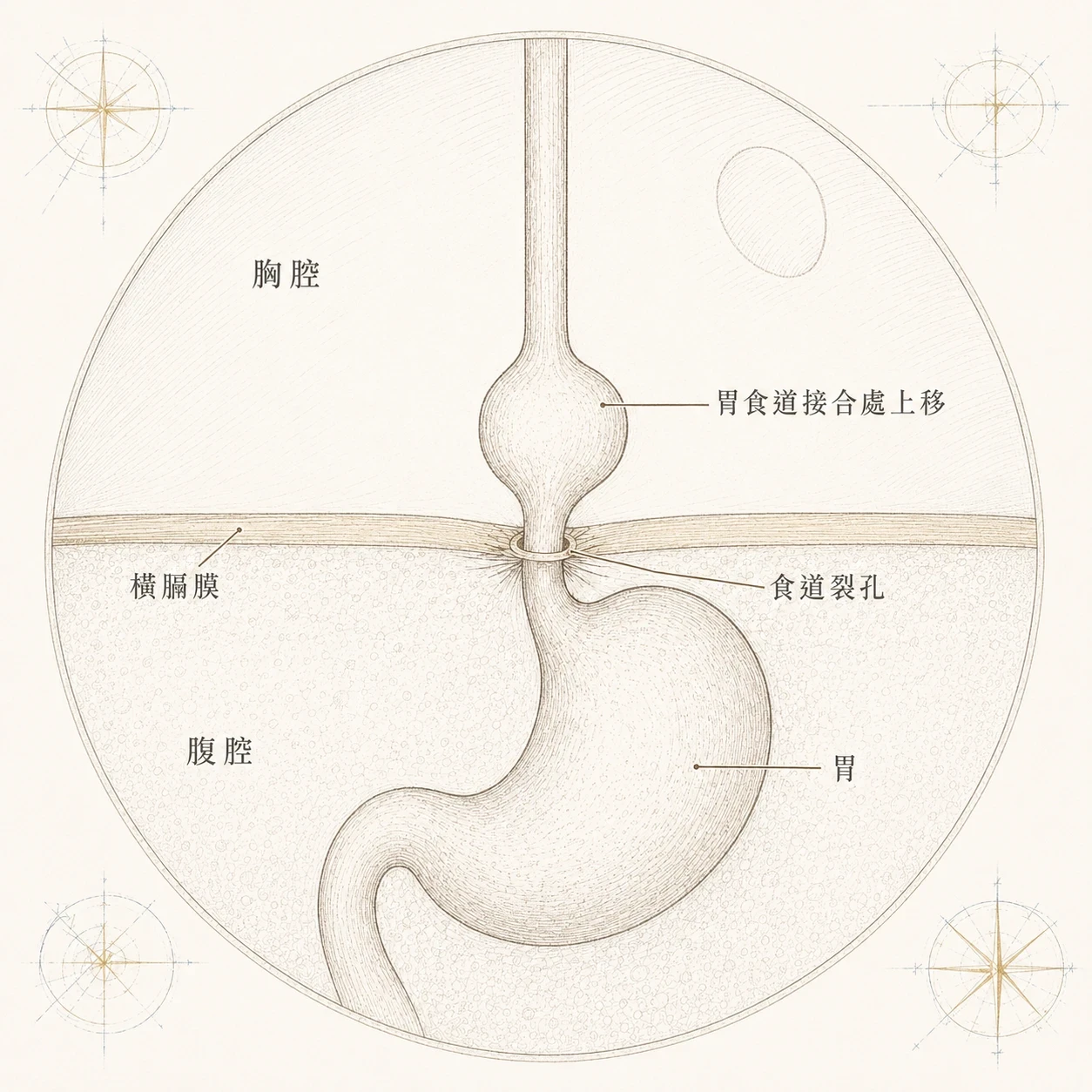 食道裂孔疝氣示意圖:胃部從橫膈膜的食道裂孔向上擠入胸腔,與腹股溝疝氣等腹壁疝氣發生的部位完全不同