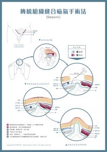 Bassini-surgery 傳統組織縫合疝氣手術法